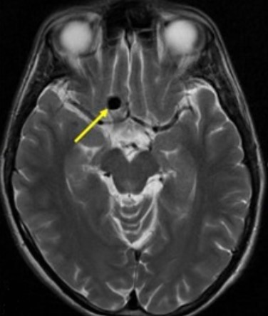 Аневризматическое расширение сосудов головного мозга на М-скане 