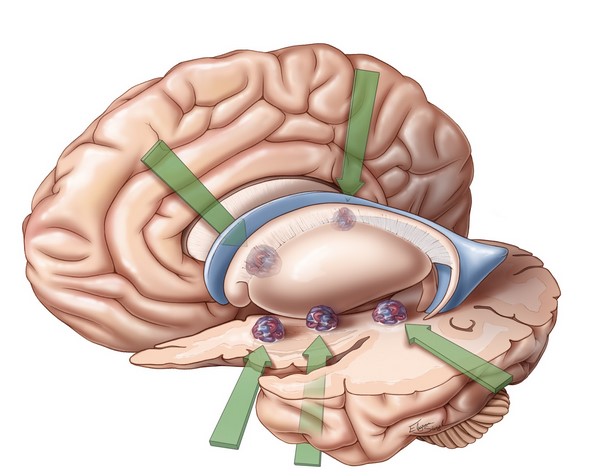 Артерио-венозные мальформации в глубинных отделах головного мозга