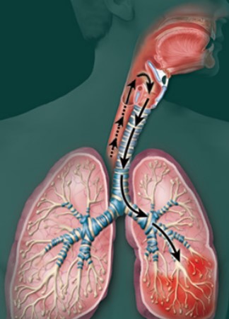 Схематичное изображение проникновения аспирата из пищеварительной трубки в дыхательную систему