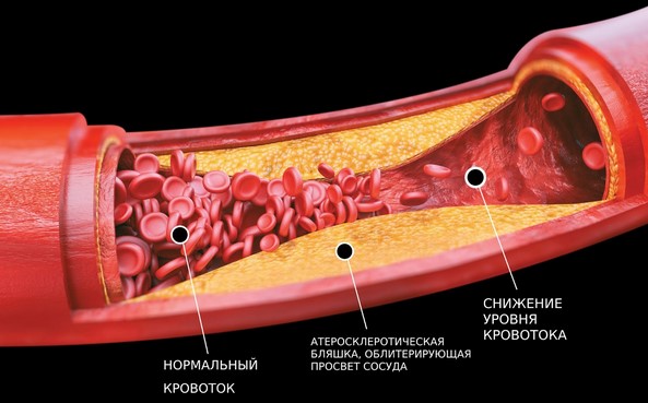Атеросклероз аорты на КТ