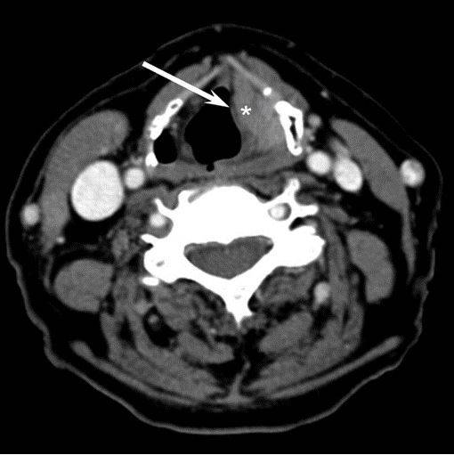 Опухоль гортани (маркирована звездочкой) в области левой голосовой связки (указана стрелкой) на компьютерной томограмме