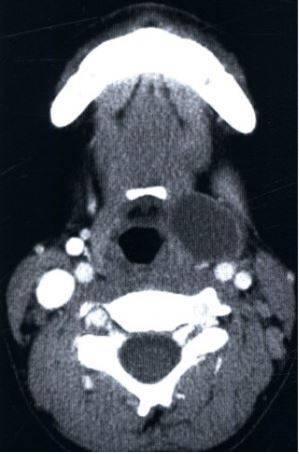 Киста щитовидно-язычного протока на компьютерной томограмме