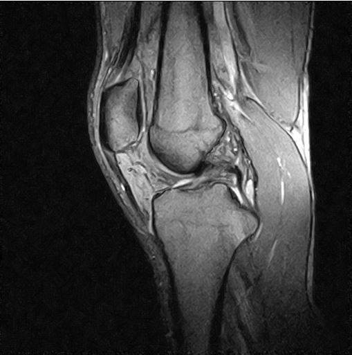 МРТ коленного сустава (сагиттальная проекция)