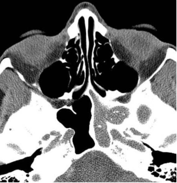 Магнитная томография околоносовых пазух: левосторонний сфеноидит