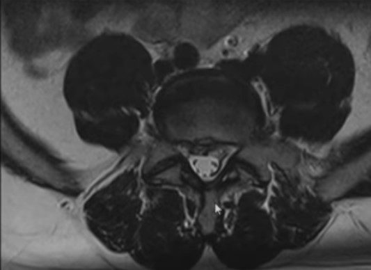 МР-снимок позвонка в аксиальной проекции