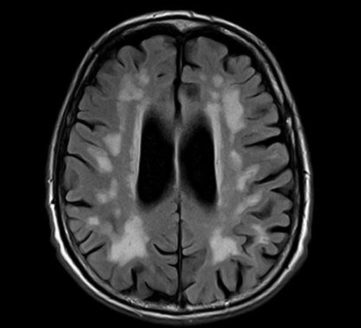 Энцефалопатия на МРТ головного мозга