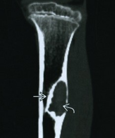 Фиброма большеберцовой кости (указана стрелками)