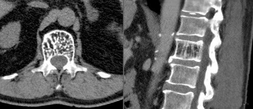 Кавернозная гемангиома на снимках КТ грудного отдела позвоночника