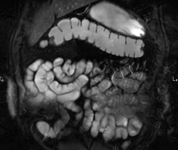 Скан МР-энтерографии 