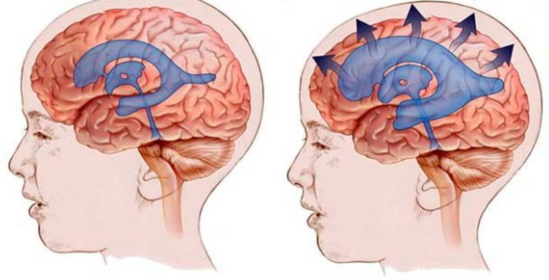 желудочки мозга в норме и при внутренней гидроцефалии