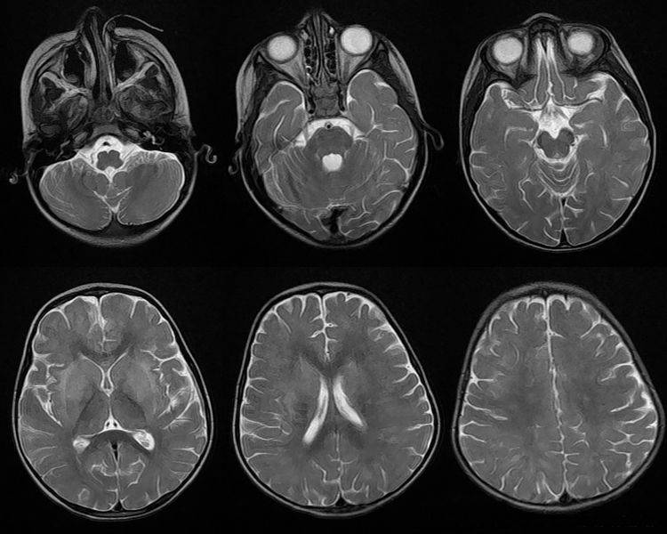 Серия послойных снимков МРТ головного мозга