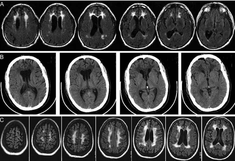 Различные формы глиоза на снимках МРТ головного мозга