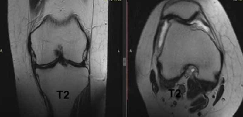 коленный сустав при МР-сканировании в разных проекциях