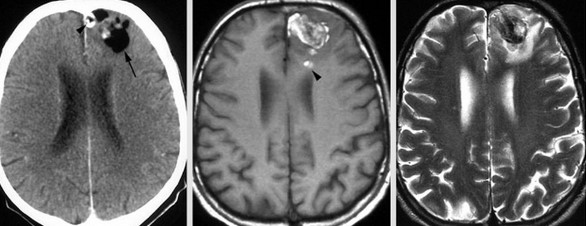 МР-снимок дермоидной кисты с неоднородным содержимым