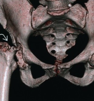 3D-реконструкция тазобедренного сустава: стрелка указывает на остеоартроз