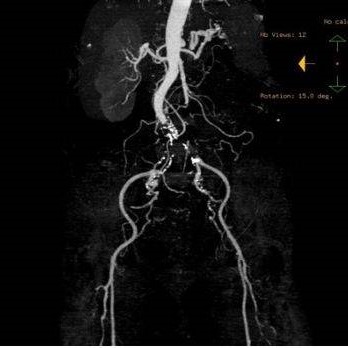 КТ ангиография подвздошной артерии
