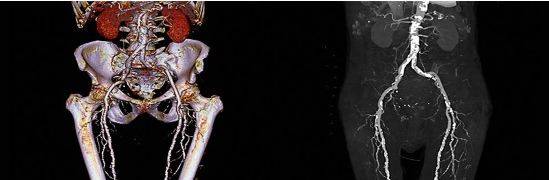 МСКТ-ангиография подвздошных артерий, 3D-реконструкция