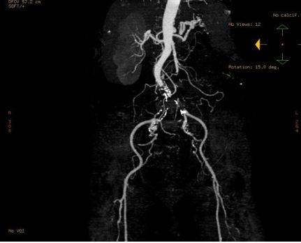 КТ-ангиография подвздошной артерии при синдроме Лериша