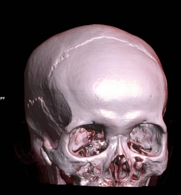 3D-модель черепа по снимкам КТ