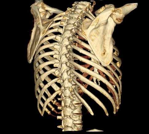 3D-реконструкция костей грудной клетки
