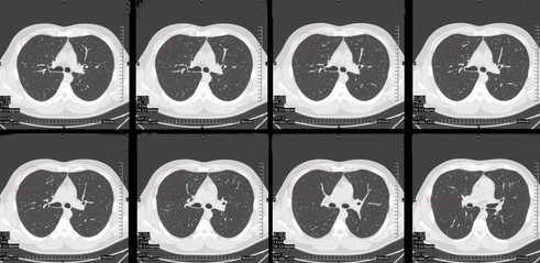 Компьютерная томография органов грудной клетки