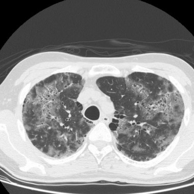 КТ или рентген при пневмонии