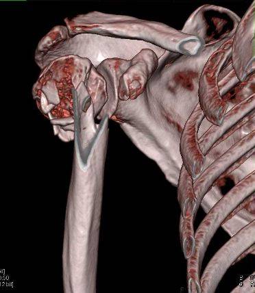 Перелом плечевой кости в проксимальном отделе на компьютерной томографии при 3D-реконструкции