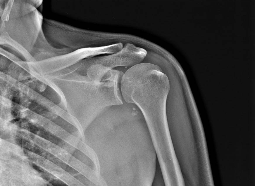 КТ плечевого сустава не причиняет боли или дискомфорта, требуется лишь лежать неподвижно во время сканирования