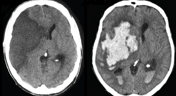 КТ головы в аксиальной проекции: ишемический (слева) и геморрагический (справа) инсульты