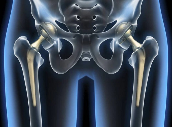  Схематичное изображение протезированных тазобедренных суставов