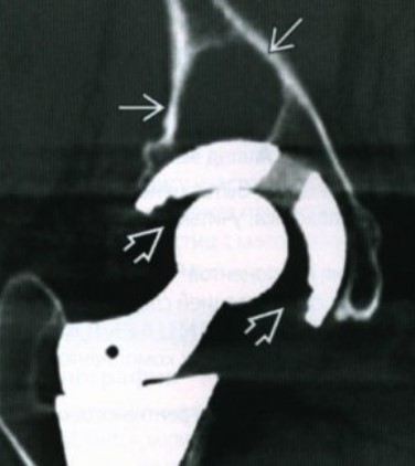 КТ искусственного тазобедренного сустава 