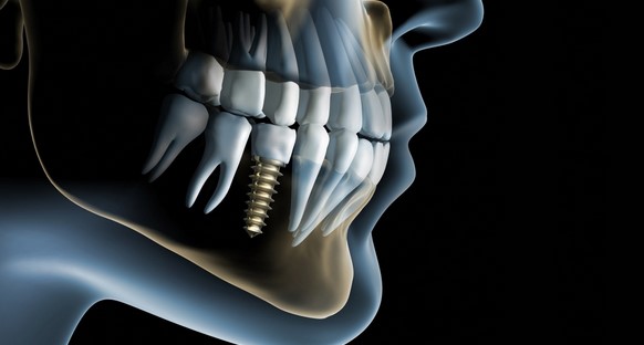Схематичное изображение расположения зубного штифта