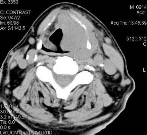 Опухоль щитовидной железы на компьютерной томографии