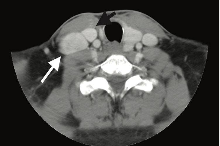 На снимке КТ белой стрелкой указан увеличенный лимфатический узел. У пациента удалена доля щитовидной железы справа (указано чёрной стрелкой), в связи с папиллярной карциномой.