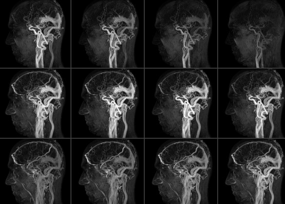 Послойные снимки при МРТ ангиографии сосудов головного мозга