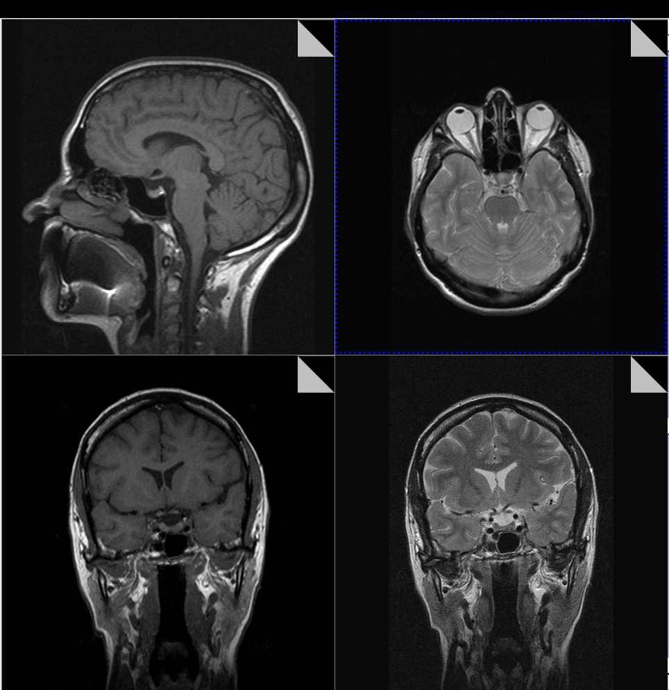 Выявление микроаденомы гипофиза с помощью МРТ: изображения в разных проекциях