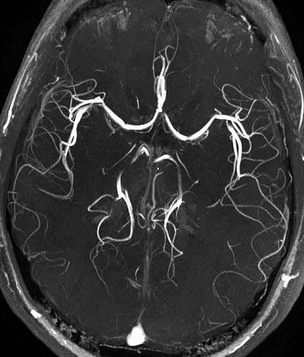 МРТ артерий головного мозга что показывает