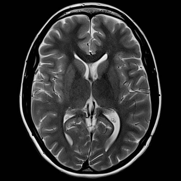 МРТ головного мозга в аксиальной проекции