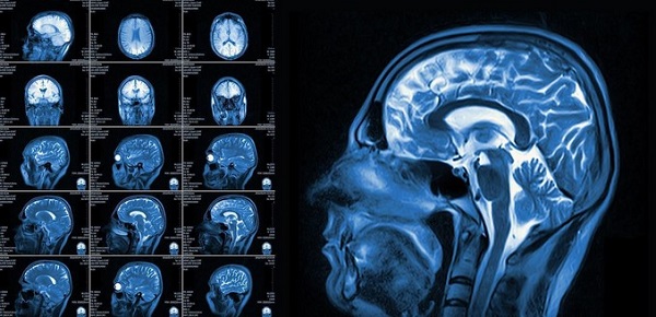 МРТ головного мозга на вазоневральный конфликт