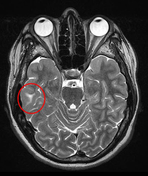  Туберозный склероз на МРТ головного мозга