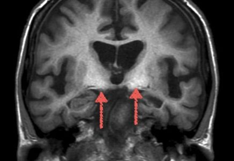 Склероз гиппокампа на МРТ головного мозга