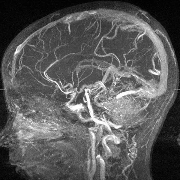 МР-ангиография головного мозга