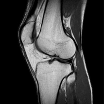 МРТ коленного сустава что показывает
