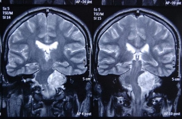 МРТ головного мозга с прицельным осмотром мостомозжечкового угла