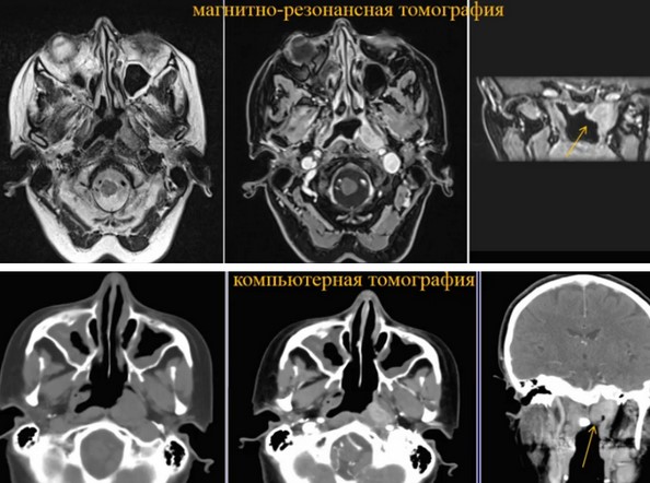 Магнитно-резонансный и компьютерный снимки в оценке опухоли 