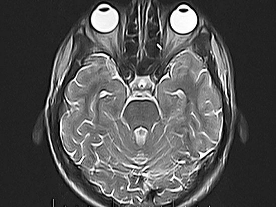 Снимок сетчатки глаз на томограмме головного мозга
