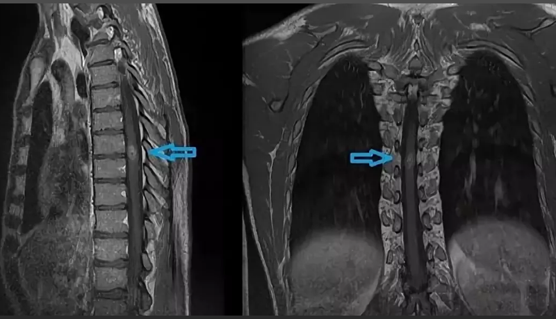 Опухоль спинного мозга в грудном отделе на МРТ