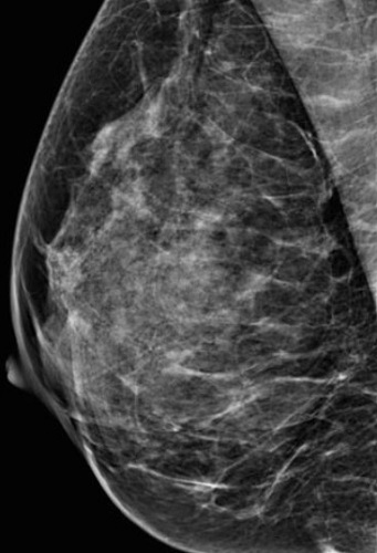 МРТ при раке груди
