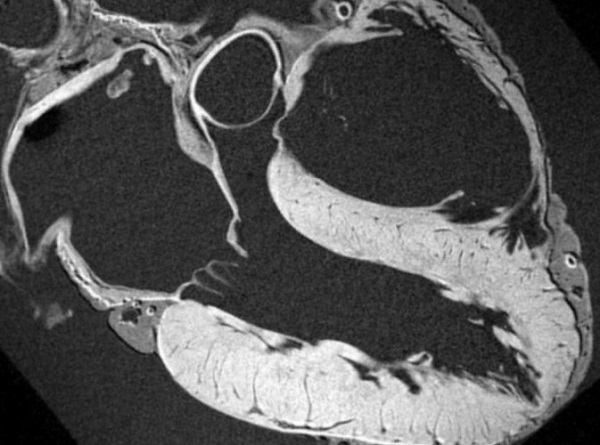МР-снимок сердца 