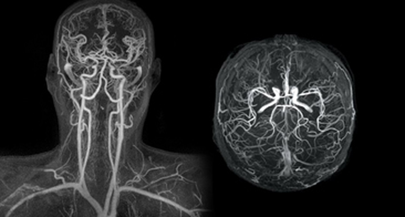МР-ангиография сосудов головы и шеи